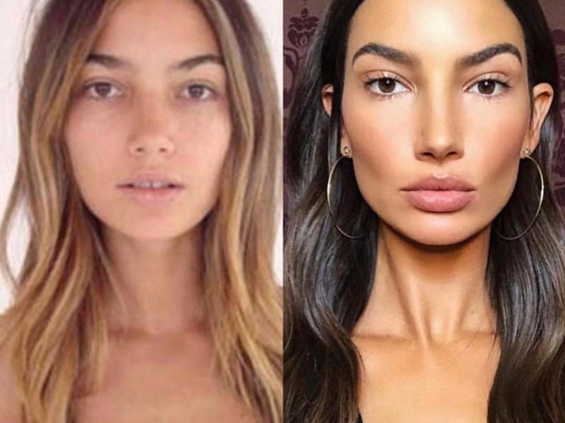 Everything You Need To Know About Getting Lip Injections